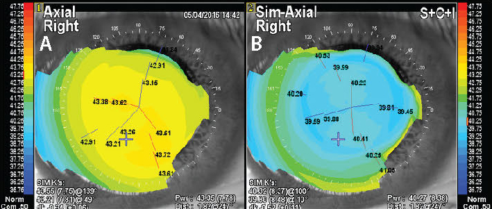 Figure 1. The axial topography on the left shows subtle irregular astigmatism (A). The right image is a simulated axial topography following CATZ (B).