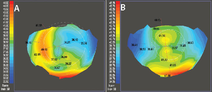 Figure 3. The left topography shows significant irregular astigmatism following full thickness penetrating keratoplasty (A). On the right is the post-operative topography one year after CATz-driven PRK (B). Best corrected spectacle improved from 20/40- to 20/25.