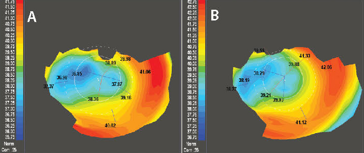 Figure 4. A moderately decentered ablation pattern from LASIK fifteen years ago is shown on the left (A). Topography after CATz shown on the right demonstrates an enlarged optical zone (B). BSCVA acuity improved from 20/40 to 20/20.