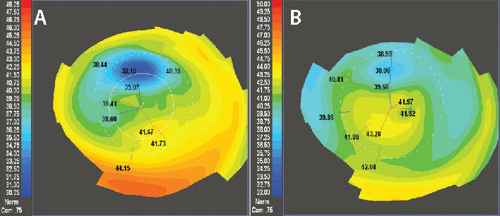 Figure 5. The left image shows a highly aberrated cornea following complicated LASIK (A). Two courses of CATz-driven PRK resulted in the improved topography shown on the right (B). The patient gained a line of BSCVA and can now tolerated a contact lens.