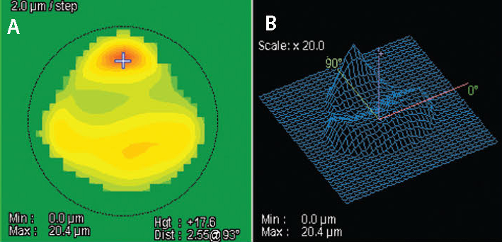 Figure 6. NIDEK’s Final Fit Software shows the theoretical ablation map needed to regularize the astigmatism in this challenging case (A). The image on the right demonstrates the tissue elevation addressed in 3D (B).